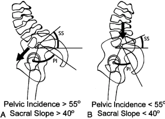 Figure  4.  Deux  mécanismes  possibles  dans  la  pathogenèse  du  spondylolisthésis  en  fonction  de  la  morphologie  sacro-pelvienne