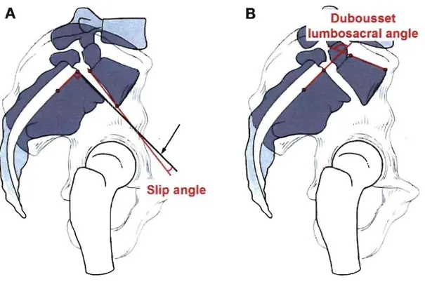 Figure  17.  Mesure  de  la  cyphose  lombosacrée  avec  A)  l'angle  de  glissement  (&#34;slip  angle&#34;)  et  B)  l'angle lombosacré de Dubousset (&#34;Dubousset lumbosacrai angle&#34;)