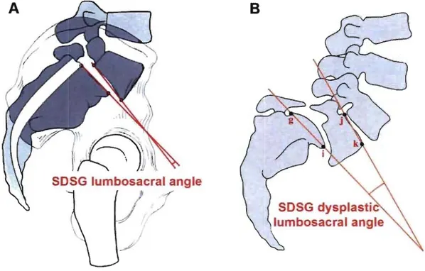 Figure  18 .  Mesure de la cyphose lombosacrée avec A)  l'angle lombosacré SDSG (&#34;SDSG lumbosacral 