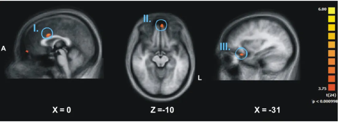 Figure  3 :  En  haut :  Images  du  cerveau  des  patients  montrant  les  régions  activées  au  cours  des  conditions 