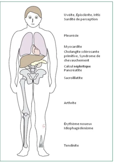 Figure 7. Manifestations extra-intestinales les plus communes affectant les patients  souffrant de MII 