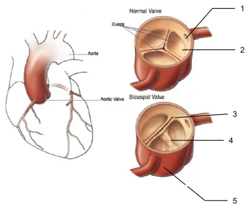Figure 1: Schéma d’une valve aortique normale et d’une valve bicuspide 