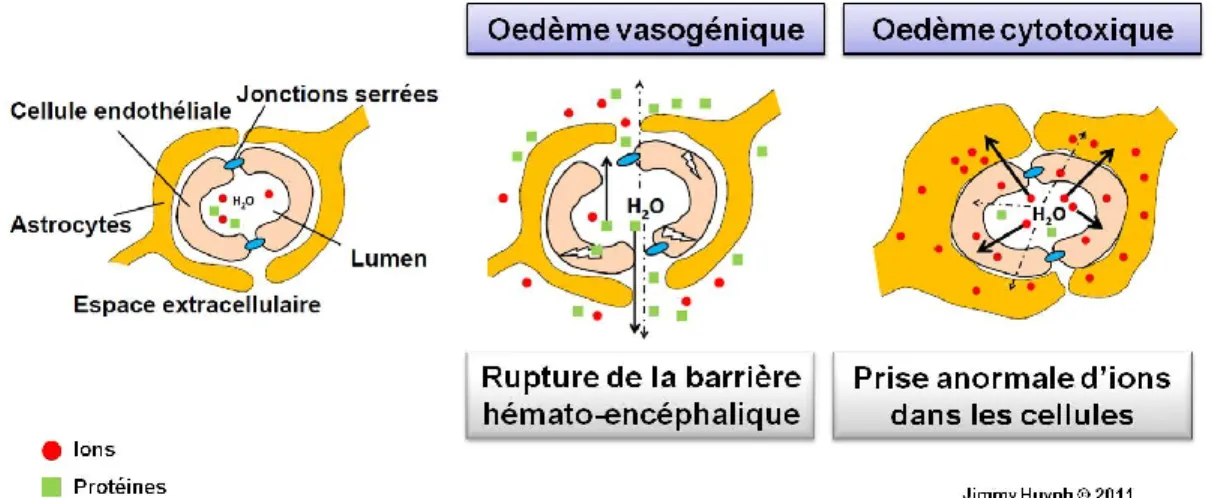 Figure 11. Oedème vasogénique et œdème cytotoxique 