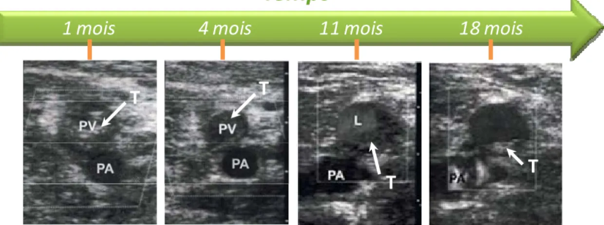 Figure 1.9: Examens ultrasonographiques en mode-B du segment poplité des membres inférieurs  (PV : veine poplitée, PA : artère poplitée, L : lumière veineuse, T : thrombus) pour un même  patient en fonction du temps