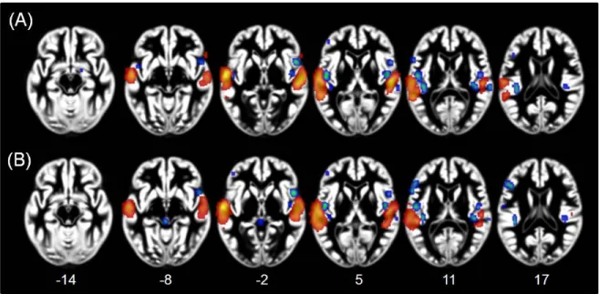 Figure 2. ALE maps showing lateralization effects for voices > music (RED-YELLOW)  and music > voices (BLUE-GREEN) comparisons (A) and for speech > music  (RED-YELLOW) and music > speech (BLUE-GREEN) comparisons (B)