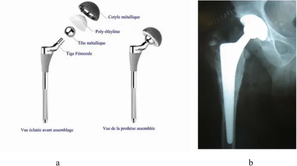 Figure 1 : Prothèse totale de hanche conventionnelle. 