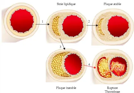 Figure 3. L’évolution de la strie lipidique. Au stade précoce de la maladie (étape 1), la 