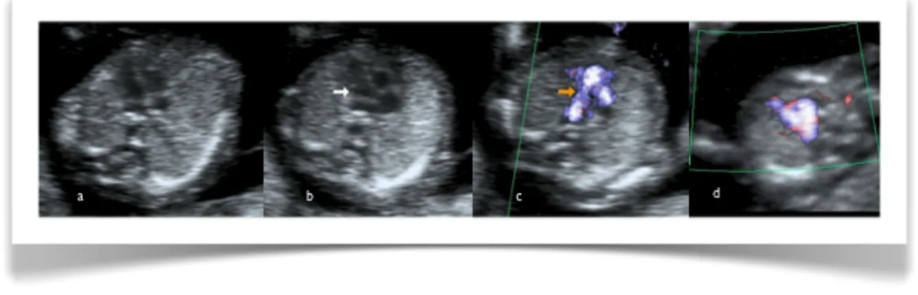 Figure 6. Cœur fœtal normal au premier trimestre  (12e  semaine) : (a) 4 chambres (b) voie  d’éjection de l’aorte (c) voie d’éjection de l’artère  pulmonaire et croisement des vaisseaux  (d) canal artériel
