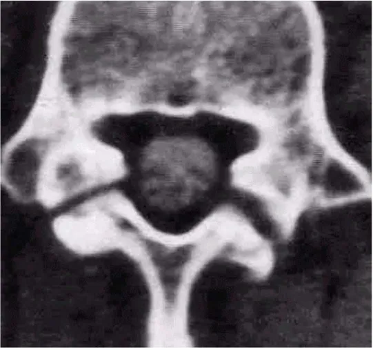 Figure 5  CT-scan en coupe axiale du spondylolisthesis 