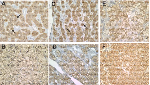 Figure 5. Distribution de la protéine β-CATÉNINE dans les tumeurs sporadiques du cortex  surrénalien