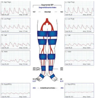 Figure 1.8:  Pulse volume recordings of a patient presenting a PAD in its left leg 9 