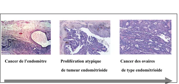 Figure  II.  Progression  histologique  et génétique  moléculaire  du  cancer  ovarien  de  type endométrioide