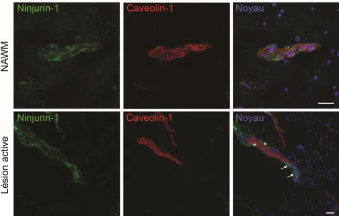 Figure 10 : L’expression de Ninjurin-1 augmente dans l’endothélium vasculaire  dans des lésions actives au sein du SNC des patients atteints de SEP  Immunohistofluoresence de Ninjurin-1  dans la matière blanche d’apparence normale  (NAWM - normal appearing