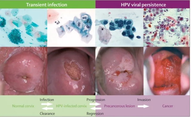 Figure 8: Major steps in the development of cervical cancer 