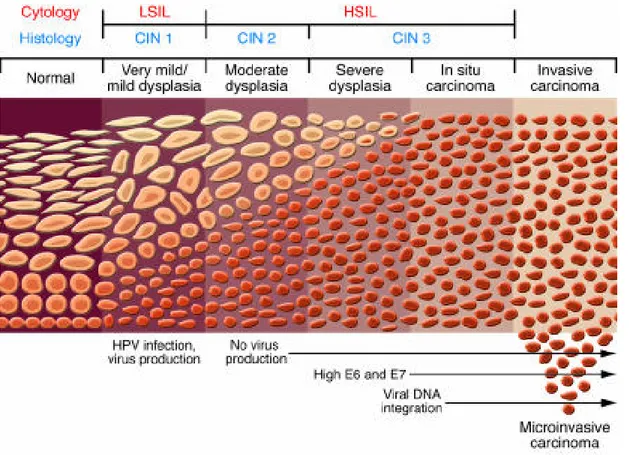 Figure 9:Progression from a benign cervical lesion to invasive cervical cancer. Infection by oncogenic HPV types,  especially HPV16, may directly cause a benign condylomatous lesion, low-grade dysplasia, or sometimes even an  early high-grade lesion