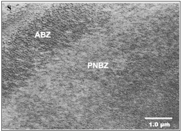 Figure 2.12:  Absence de membrane de Descemet postérieure (PNBZ) dans la Dystrophie de 