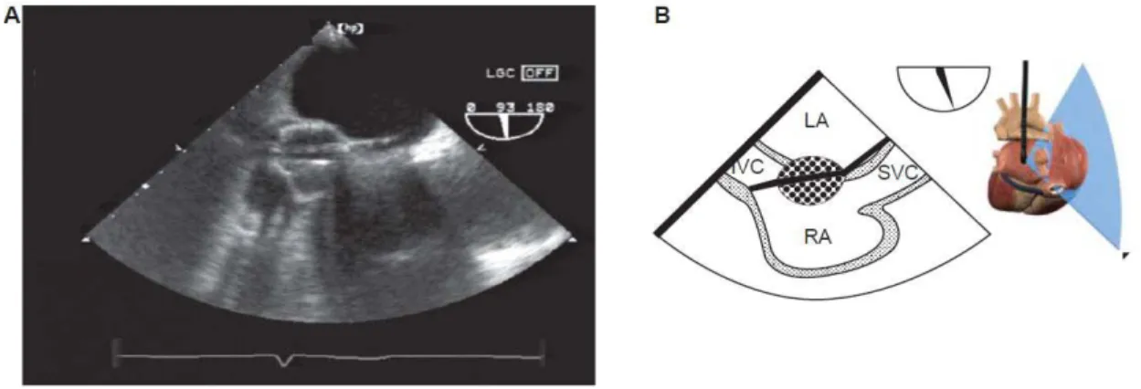 Figure 6 Retrograde cardioplegia cannula 