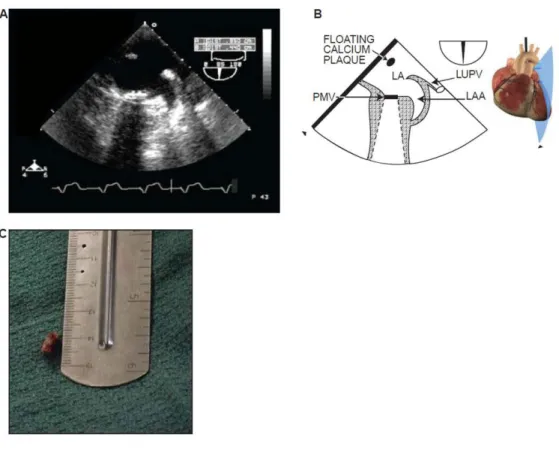 Figure 7 Calcium emboli in valvular surgery 
