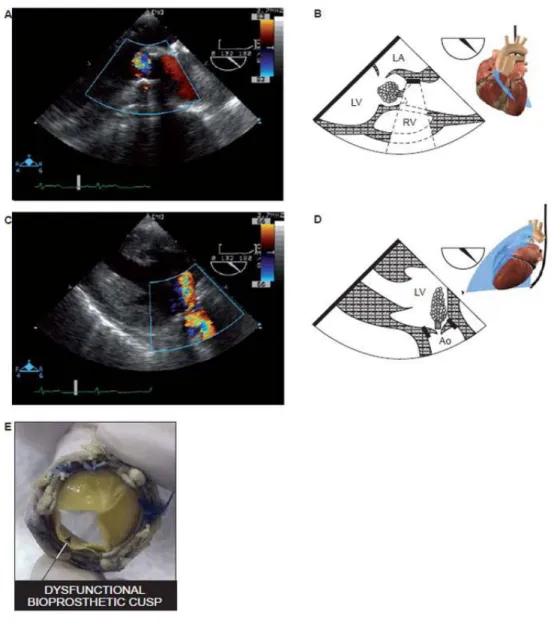 Figure 8 Dysfunctional AoV bioprosthesis after AVR 