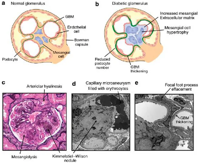 Figure 1-8. Les changements glomérulaires et des cellules mésangiales dans les maladies rénales