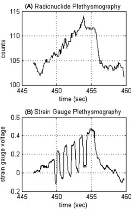 Figure  5.  Example  of  movement  artifacts  detected  by  strain  gauge  and  radionuclide  plethysmography  and  created  by  discrete  movements  of  the  patient  finger
