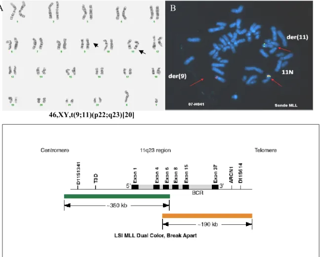 Figure 8: Caryotype et FISH du patient 07H041 présentant la t(9;11)(p22;q23).              