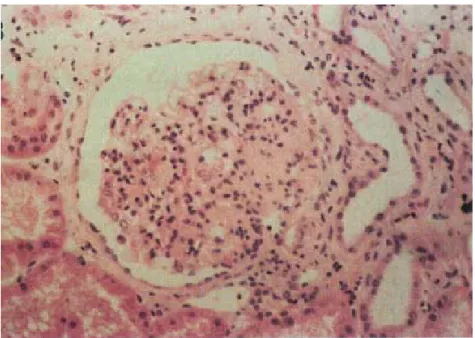 Figure 3-6. Renal cortical biopsy from a RCS patient (278)  3.6.4. Animal Models of Pax2 Mutations   