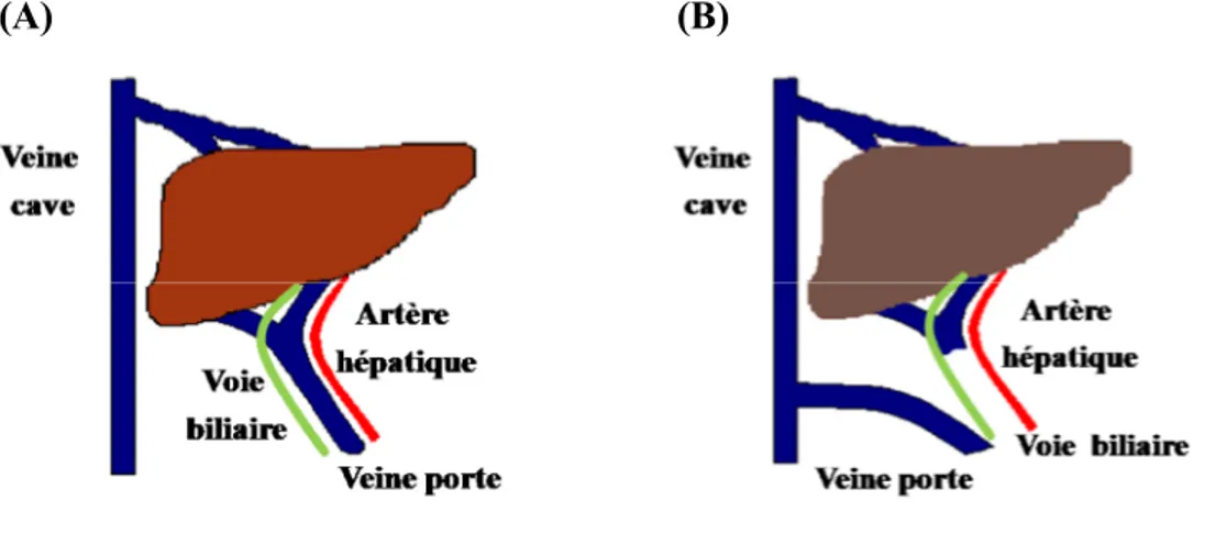 Figure 5.  Anastomose portocave (portacaval anastomosis PCA)  