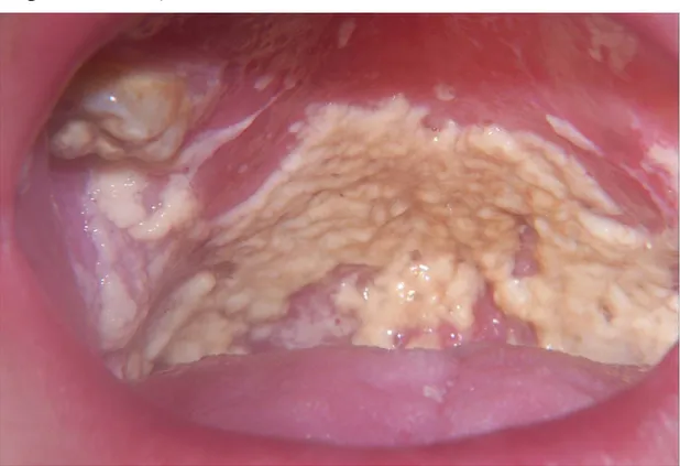 Figure 5 – La candidose oro-pharyngée pseudomembraneuse (image tirée de 