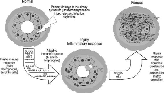 Figure 2. Concept général de la pathogénèse de la BO. Une agression primaire à  l'allogreffe pulmonaire conduit à l'activation du système immunitaire inné, qui est  suivit par l'activation du système immunitaire adaptatif