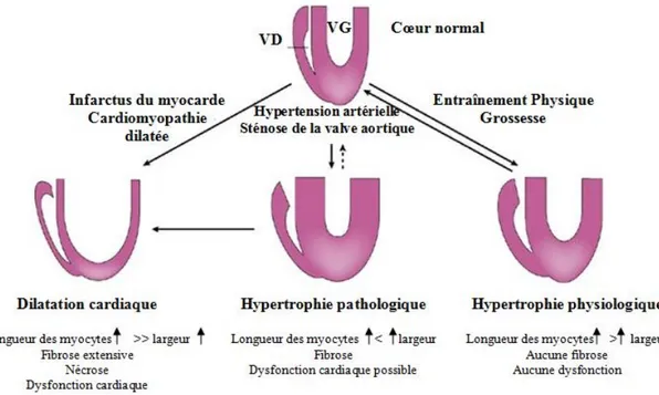 Figure 6. Divers types d'hypertrophie cardiaque. 