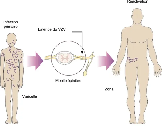 Figure 1. Pathologies causées par le varicella-zoster virus (adaptée de Weaver,  2009)