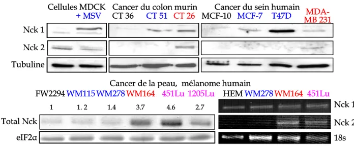 Figure 8 : Niveaux d’expression de Nck1 et Nck2 au cours de la progression de différents  cancers  111  © Salma Ismail et Louise Larose, 2006