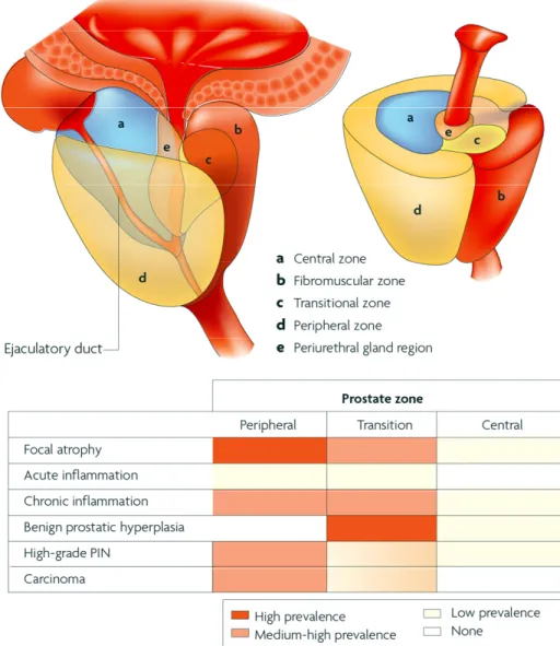 Figure 1. Zonal predisposition of prostate disease.  