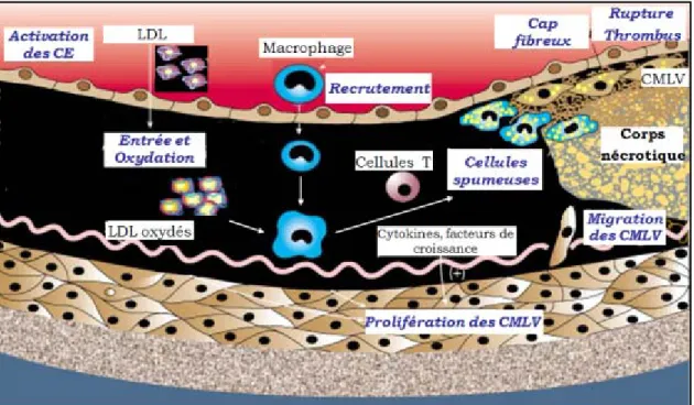 Figure 4. Évolution de la plaque d’athérosclérose. L’accumulation et l’oxydation 