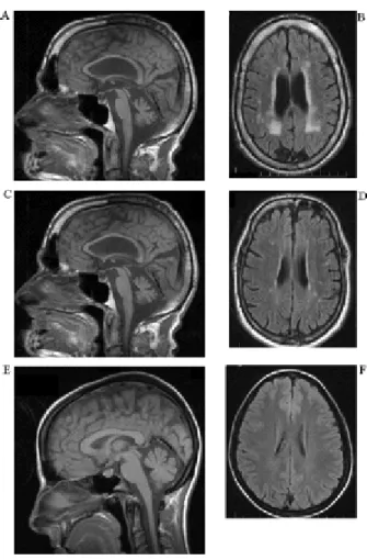 Fig. 2 Sagittal and coronal T 2 -weighted MRI sequences demonstrating 