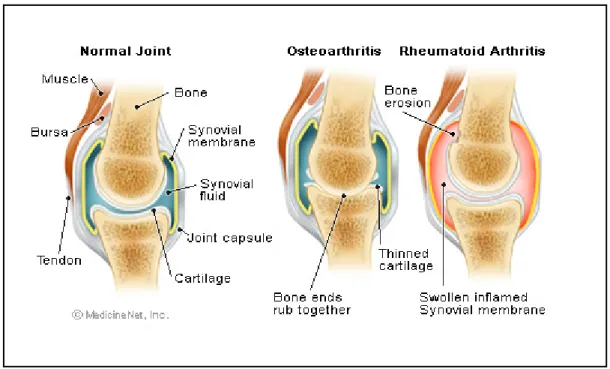 Figure 7: Articulation saine et articulations atteintes d’ostéoarthrite et d’arthrite  rhumatoïde