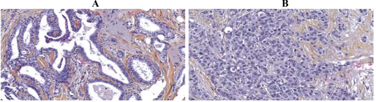 Figure 3. Coupes histologiques de carcinomes mammaires colorées à l’Hématoxyline- l’Hématoxyline-Éosine-Safran (HES) : (A) un carcinome de bas grade (I); (B) un carcinome de haut grade  (III)