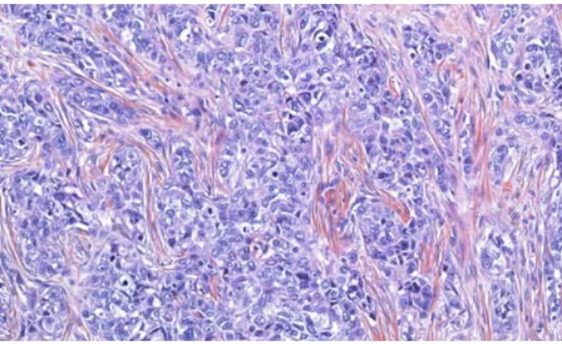 Figure 4. Coupe histologique d’un carcinome mammaire infiltrant canalaire colorée à  l’Hématoxyline-Éosine-Safran (HES)