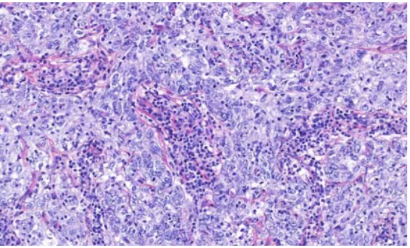 Figure 5. Coupe histologique d’un carcinome mammaire médullaire colorée à  l’Hématoxyline-Éosine-Safran (HES)