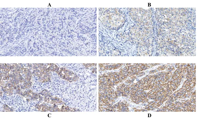 Figure 6. Marquage membranaire de la protéine HER-2 à différents niveaux dans le  carcinome mammaire de haut grade : (A) 0 (négatif); (B) 1+ (négatif); (C) 2+ (douteux);  (D) 3+ (positif)