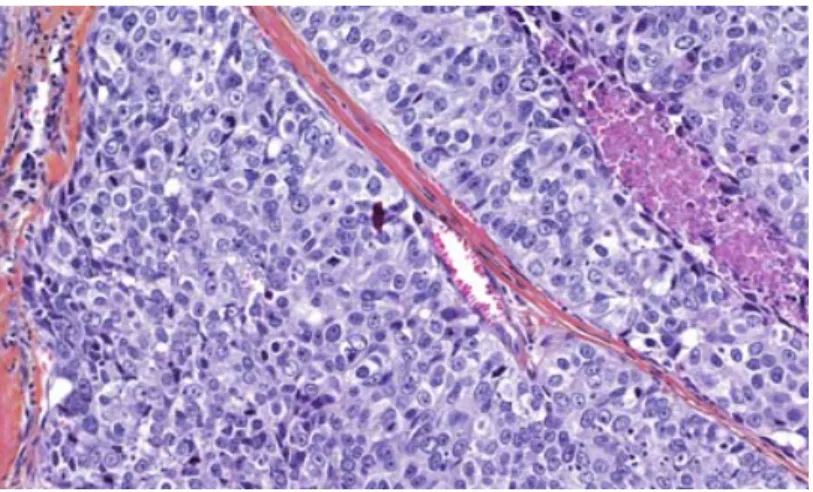 Figure 7. Coupe histologique d’un carcinome mammaire canalaire de phénotype basal  colorée à l’Hématoxyline-Éosine-Safran (HES)