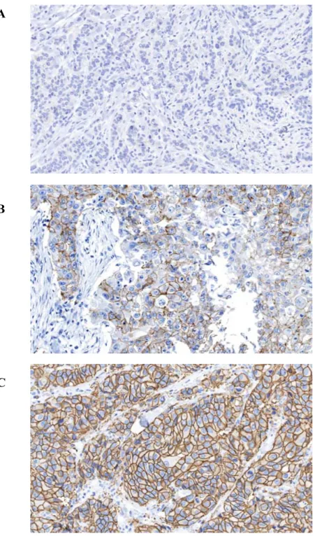 Figure 12. Marquage membranaire de HER-2 à différents niveaux dans le carcinome  mammaire de haut grade : (A) négatif : moins de 10% de cellules positives; (B) modéré : de  10% à 70% de cellules positives; (C) fort : plus de 70% de cellules positives