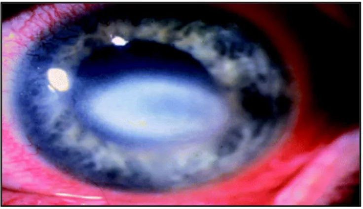 Figure 8 Oeil infecté avec Acanthamoeba 