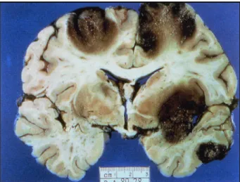 Figure 9 Section coronale des hémisphères  cérébraux d'un patient décédé de EGA 