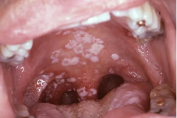 Figure 3 : La candidose pseudomembranaire 