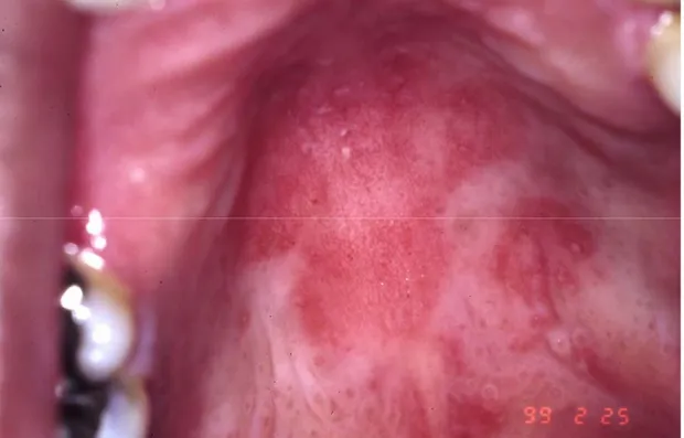 Figure 4 : La candidose érythémateuse 