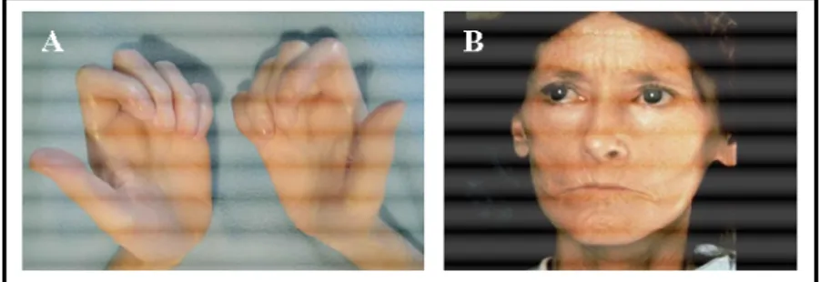 Figure 1. Manifestations cliniques de la sclérose systémique. (Propriété de ISN Photo  Repository)