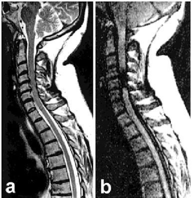 Figure   2.15. DW-MRI in spinal cord compression 