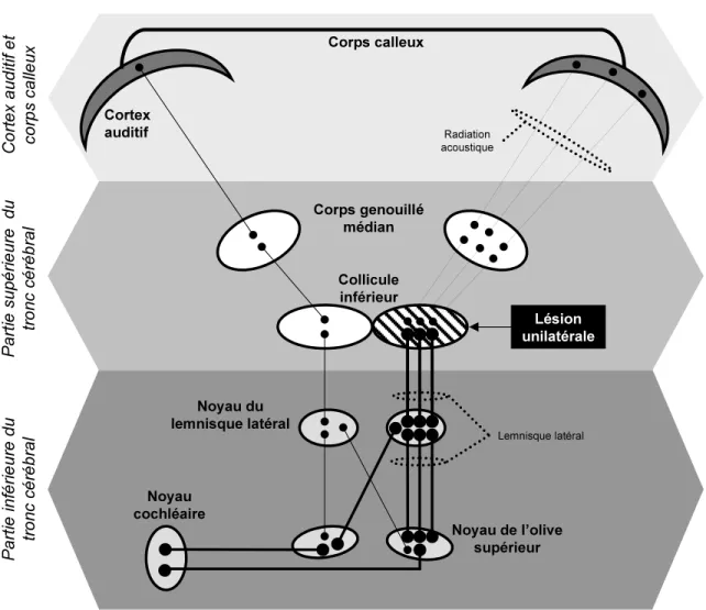 Figure 8 : Schématisation possible des voies auditives afférentes suite à une lésion unilatérale 